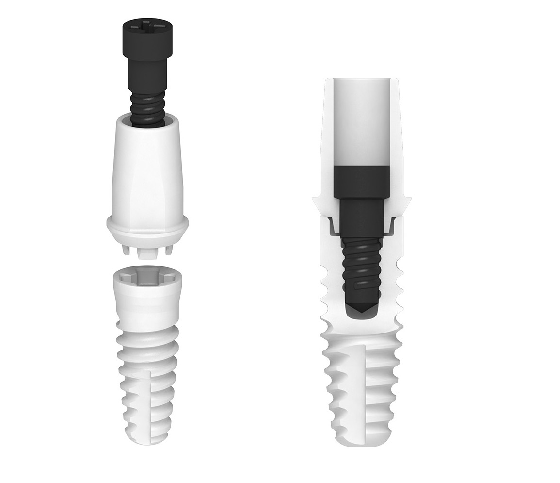Verbundprinzip eines Zeramex-Implantates mit PEEK-Schraube aus hochfesten Kunststoff